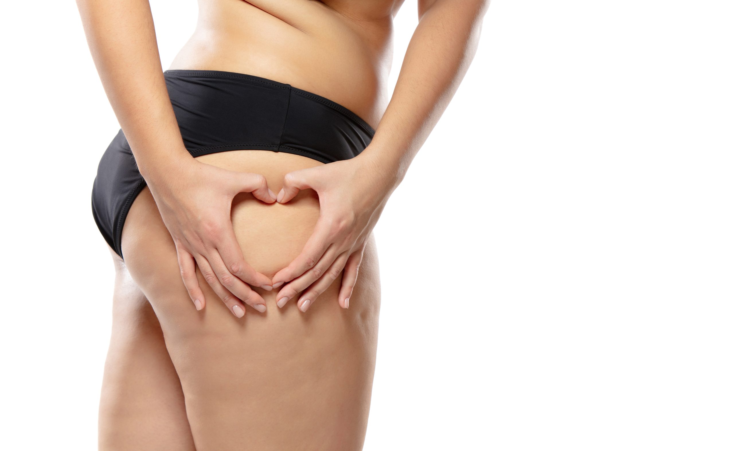 tratar estrías de forma natural